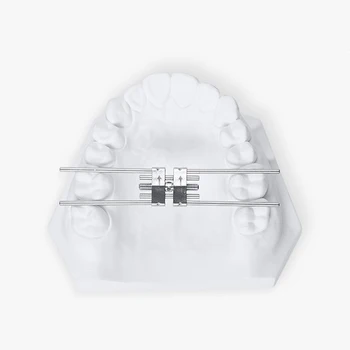Diş ortodonti spiral pedikül genişletici ortak stent ortodonti ortodontik pedikül genişletici ağız malzemeleri